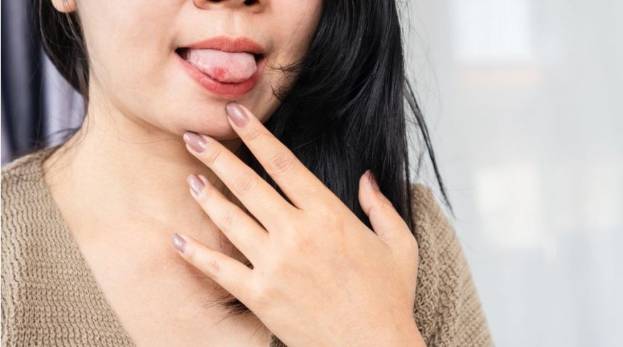 afte-in-bocca-cause-sintomi-e-trattamenti-efficaci