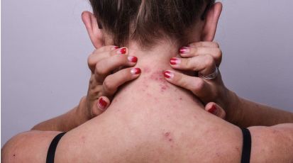 dermatite-atopica-sintomi-cura-e-prodotti-efficaci