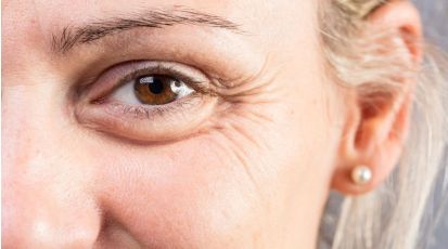 combattere-le-zampe-di-gallina-causa-rimedi-e-prevenzione