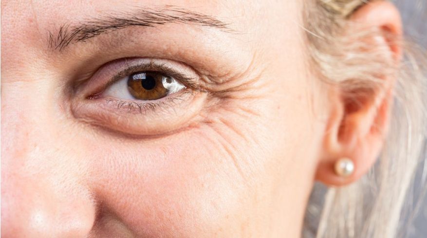 combattere-le-zampe-di-gallina-causa-rimedi-e-prevenzione